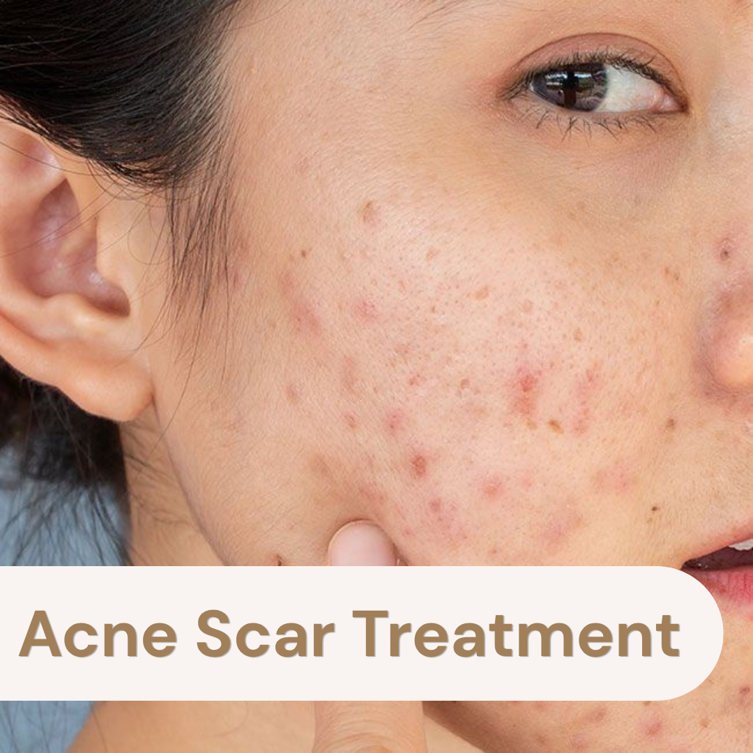 Acne Scar Treatment poster