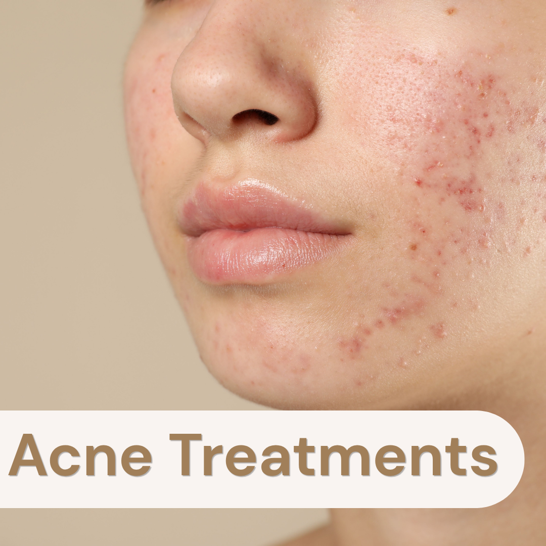 Acne Treatment poster