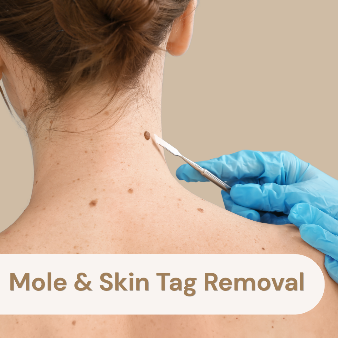 Mole & Skin Tag Removal