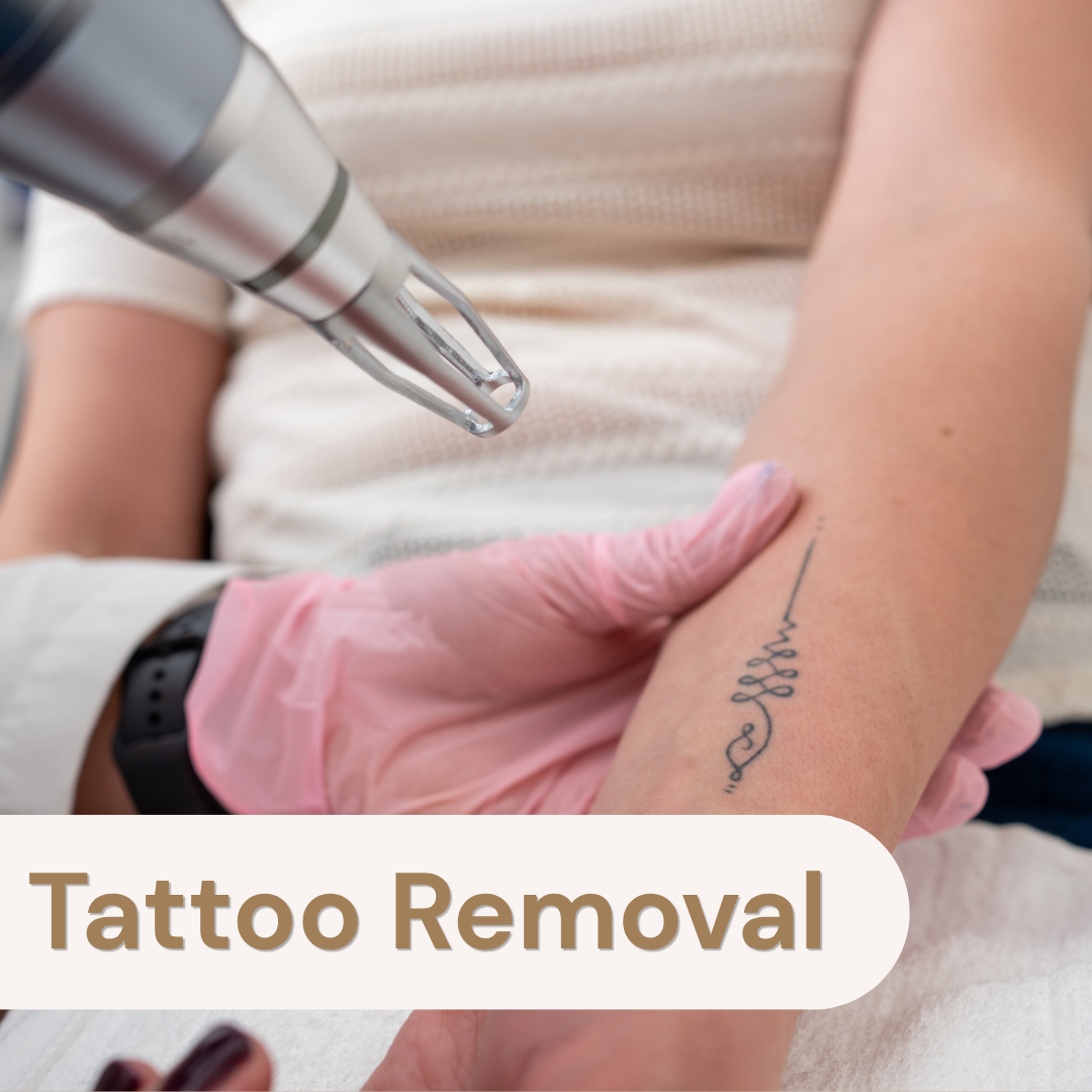 Tattoo Removal